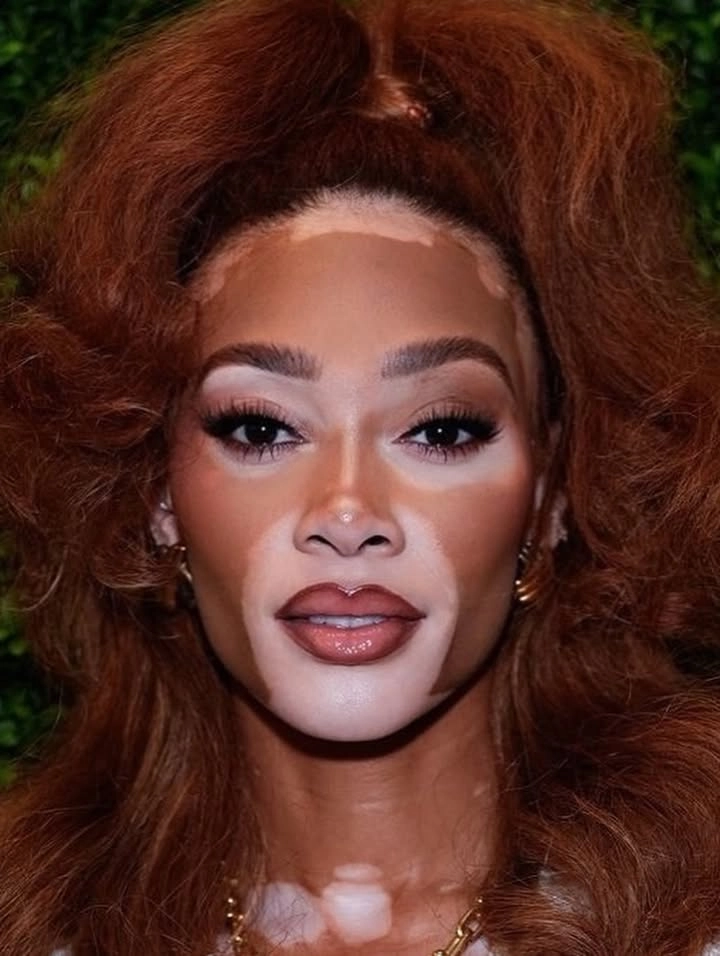 Winnie Harlow age siêu mẫu sinh năm 1994