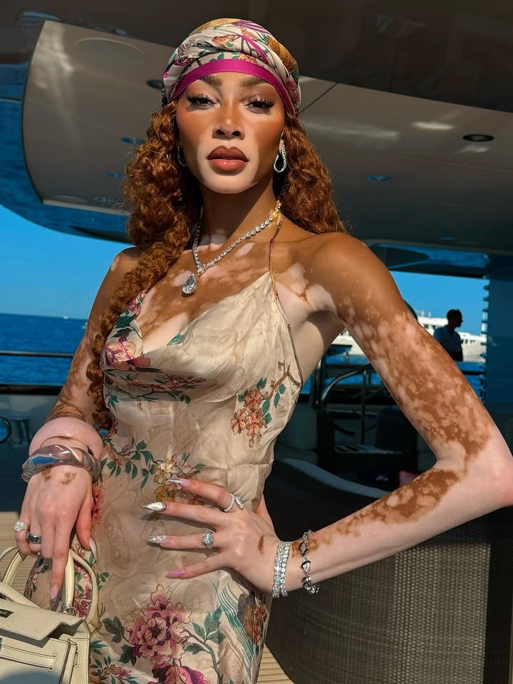 Model Winnie Harlow và vẻ đẹp độc đáo, phá vỡ mọi quy chuẩn