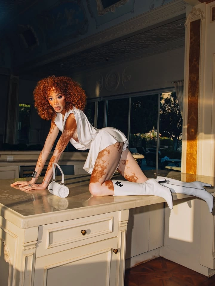 Winnie Harlow skin (làn da) và vẻ đẹp của làn da bạch biến